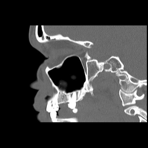 Cleft hard palate and alveolus (Radiopaedia 63180-71710 Sagittal bone window 32).jpg
