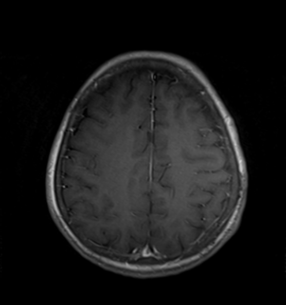 File:Clival meningioma (Radiopaedia 53278-59248 Axial T1 C+ 18).jpg
