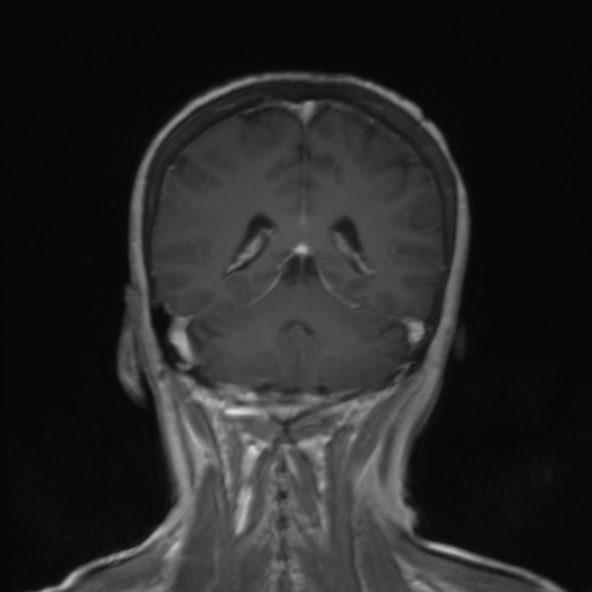 File:Clival meningioma (Radiopaedia 53278-59248 F 20).jpg