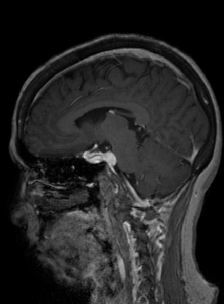 Clival meningioma (Radiopaedia 53278-59248 Sagittal T1 C+ 272).jpg