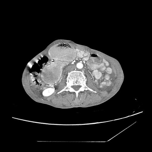 Closed-loop obstruction due to peritoneal seeding mimicking internal hernia after total gastrectomy (Radiopaedia 81897-95864 A 96).jpg