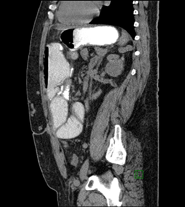Closed-loop small bowel obstruction-internal hernia (Radiopaedia 78439-91096 C 59).jpg