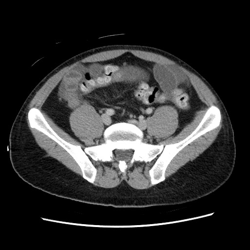 File:Closed-loop small bowel obstruction (Radiopaedia 73713-84509 A 119).jpg