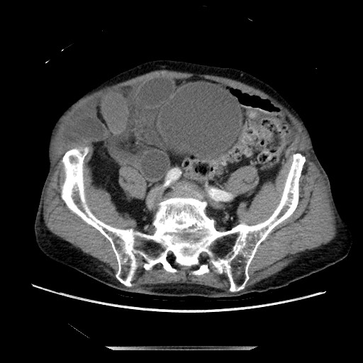 File:Closed loop small bowel obstruction - adhesive disease and hemorrhagic ischemia (Radiopaedia 86831-102990 A 134).jpg