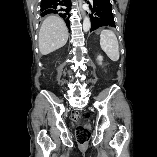 File:Closed loop small bowel obstruction - adhesive disease and hemorrhagic ischemia (Radiopaedia 86831-102990 B 93).jpg