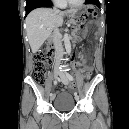 File:Closed loop small bowel obstruction - omental adhesion causing "internal hernia" (Radiopaedia 85129-100682 B 63).jpg