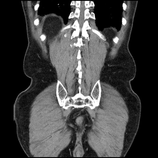 Closed loop small bowel obstruction due to adhesive band - U-shaped loop (Radiopaedia 83829-99012 B 43).jpg
