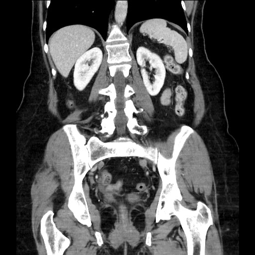 Closed loop small bowel obstruction due to adhesive bands - early and late images (Radiopaedia 83830-99014 B 85).jpg
