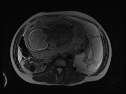 File:Closed loop small bowel obstruction in pregnancy (MRI) (Radiopaedia 87637-104031 D 2).jpg