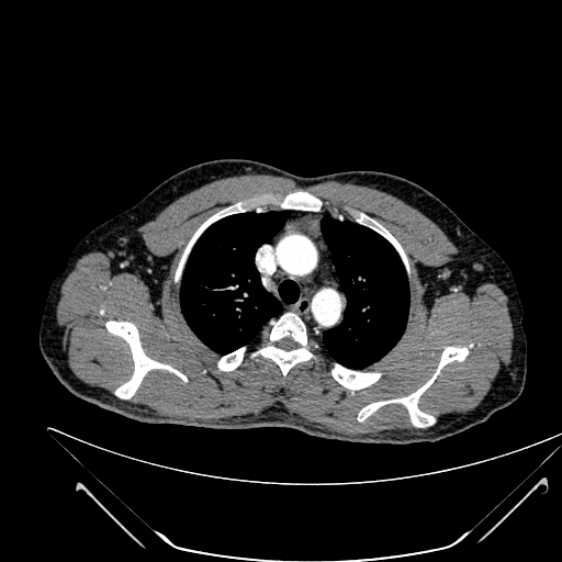 File:Coarctation of the aorta (Radiopaedia 49784-55050 B 45).jpg