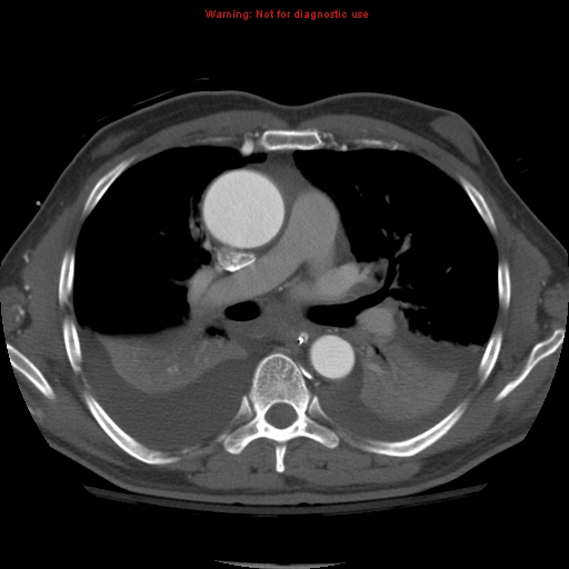 File:Coarctation of the aorta (Radiopaedia 8681-9490 B 31).jpg