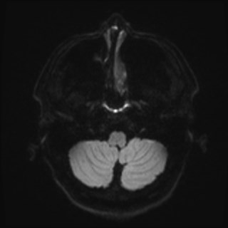 File:Cochlear incomplete partition type III associated with hypothalamic hamartoma (Radiopaedia 88756-105498 Axial DWI 46).jpg