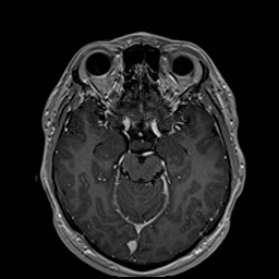 File:Cochlear incomplete partition type III associated with hypothalamic hamartoma (Radiopaedia 88756-105498 Axial T1 C+ 83).jpg