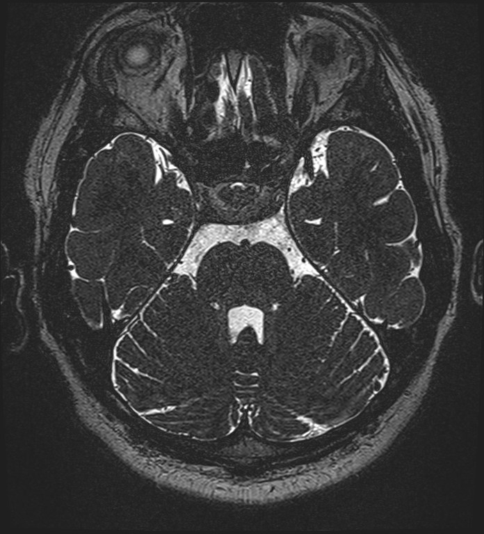 Cochlear incomplete partition type III associated with hypothalamic hamartoma (Radiopaedia 88756-105498 Axial T2 109).jpg