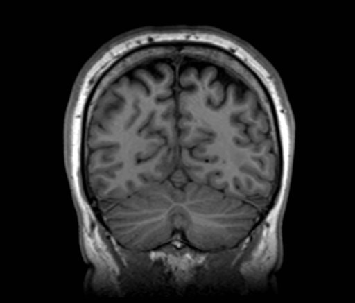 File:Cochlear incomplete partition type III associated with hypothalamic hamartoma (Radiopaedia 88756-105498 Coronal T1 17).jpg