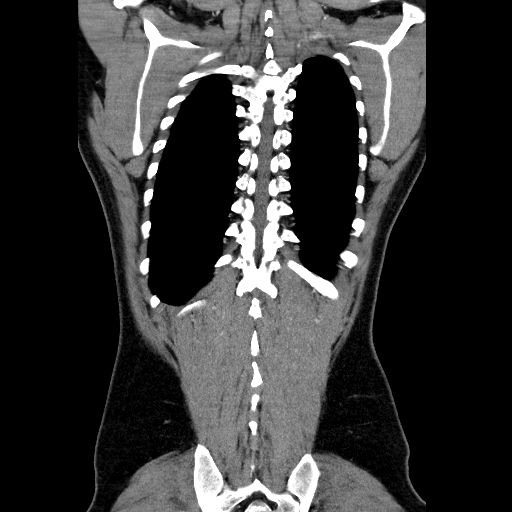 File:Codominant double aortic arch (Radiopaedia 56012-62637 B 41).jpg