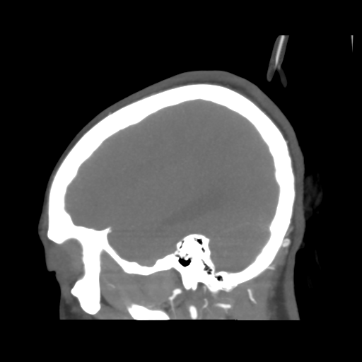 File:Colloid cyst (resulting in death) (Radiopaedia 33423-34499 B 12).png