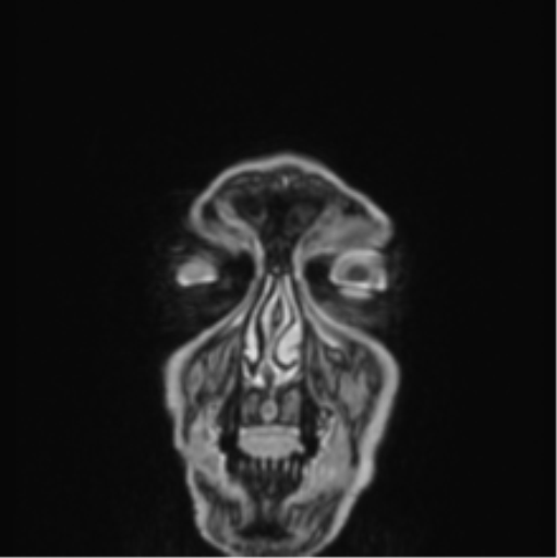 File:Colloid cyst of the third ventricle (Radiopaedia 86571-102662 Coronal T1 C+ 90).png
