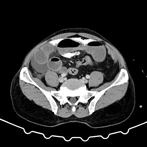 File:Colocolic intussusception due to large lipoma (Radiopaedia 68773-78482 A 136).jpg