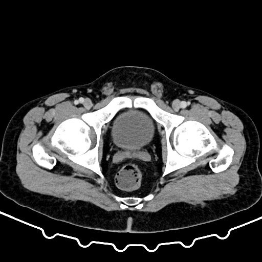 Colocolic intussusception due to large lipoma (Radiopaedia 68773-78482 A 186).jpg
