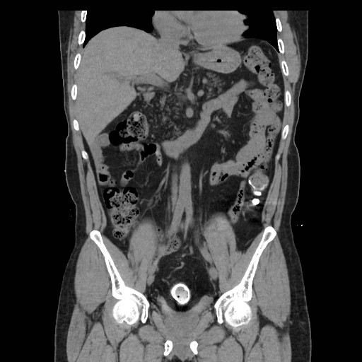 File:Colocutaneous fistula in Crohn's disease (Radiopaedia 29586-30093 E 17).jpg