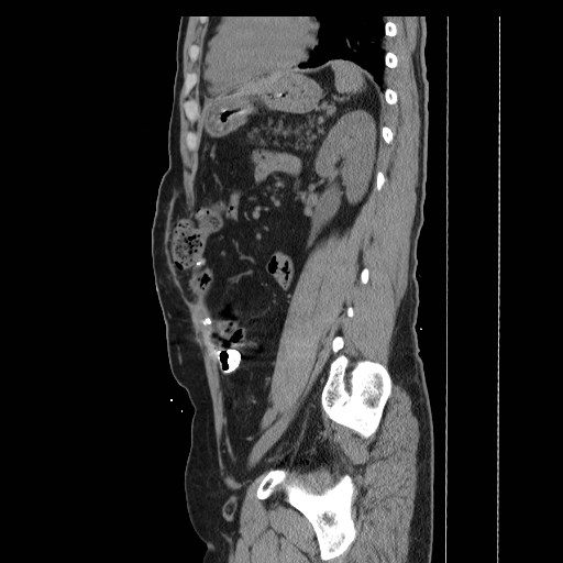 Colocutaneous fistula in Crohn's disease (Radiopaedia 29586-30093 F 31).jpg