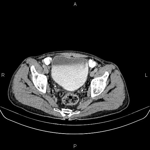 File:Colon adenocarcinoma - hepatic flexure (Radiopaedia 85635-101395 Axial C+ delayed 85).jpg