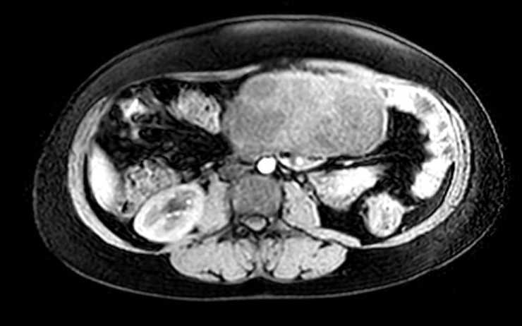 File:Colon adenocarcinoma with Krukenberg tumors, advanced pregnancy (Radiopaedia 67279-76645 A 45).jpg