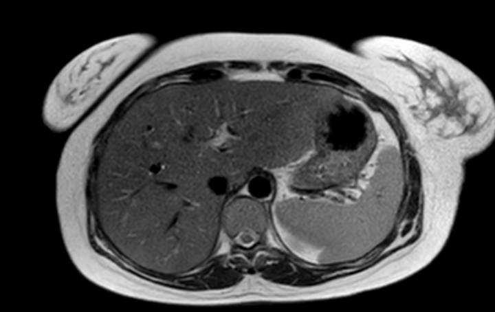 Colon adenocarcinoma with Krukenberg tumors, advanced pregnancy (Radiopaedia 67279-76645 Axial T2 69).jpg