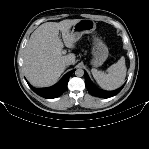 File:Colonic lipoma with colo-colic intussusception (Radiopaedia 58944-66200 Axial C+ rectal 7).jpg