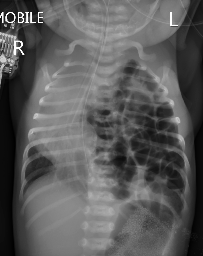 File:Congenital diaphragmatic hernia (Radiopaedia 49055).png