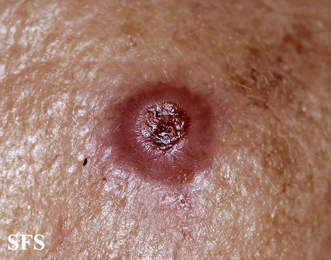 File:Melanoma (Dermatology Atlas 20).jpg