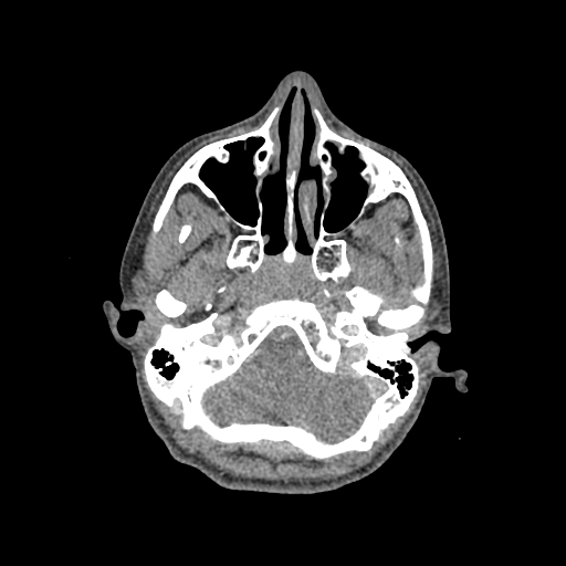 Nasal pyogenic granuloma (lobular capillary hemangioma) (Radiopaedia 85536-101244 C 68).jpg