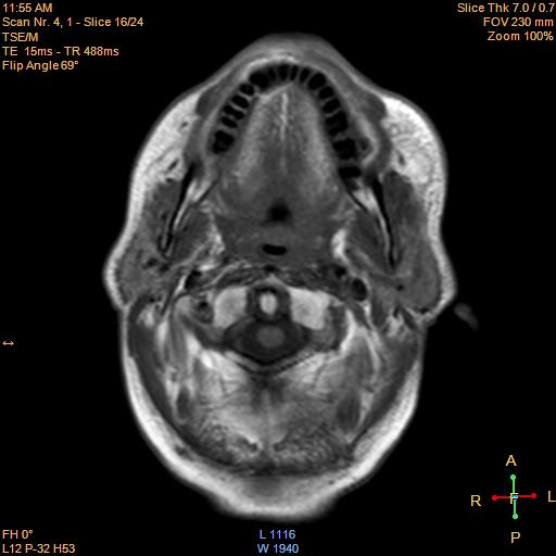 File:Nasopharyngeal carcinoma (Radiopaedia 22375-22403 Axial T1 9).jpg