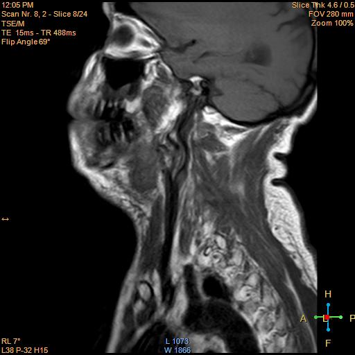 File:Nasopharyngeal carcinoma (Radiopaedia 22375-22403 Sagittal T1 3).jpg