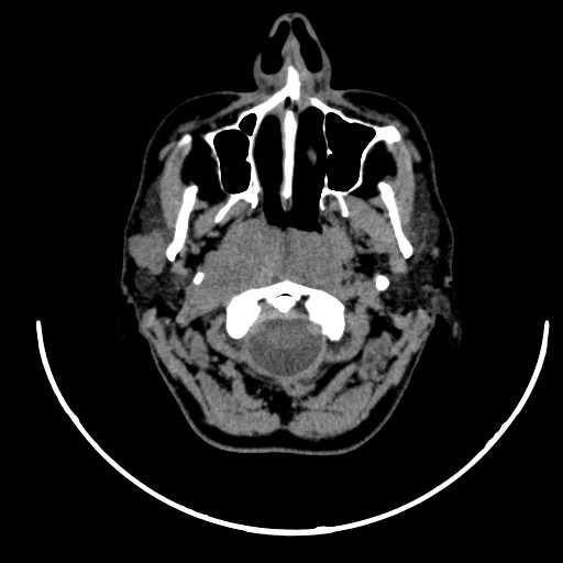 File:Nasopharyngeal carcinoma - infiltrating the clivus (Radiopaedia 62583-70875 Axial non-contrast 19).jpg