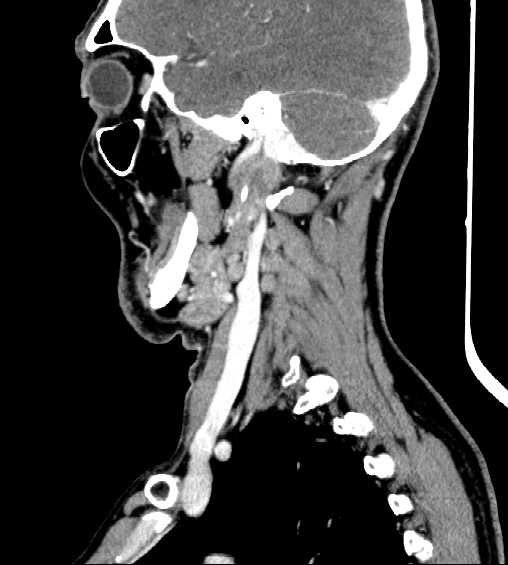 File:Nasopharyngeal carcinoma - infiltrating the clivus (Radiopaedia 62583-70875 C 15).jpg