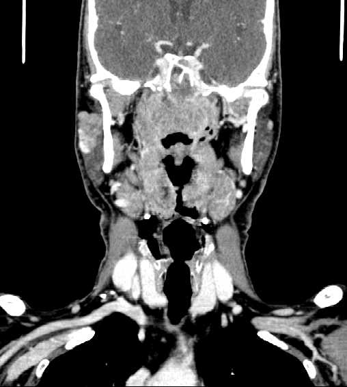 File:Nasopharyngeal carcinoma - infiltrating the clivus (Radiopaedia 62583-70875 D 21).jpg