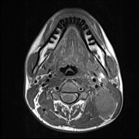 File:Nasopharyngeal carcinoma with skull base invasion (Radiopaedia 53415-59485 Axial T1 45).jpg