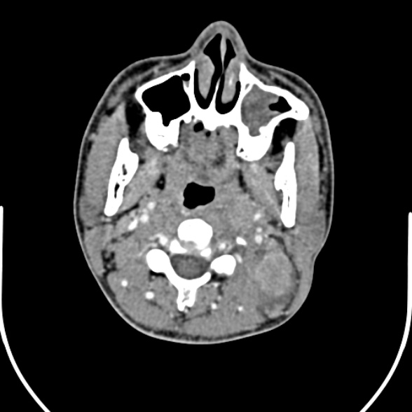 Nasopharyngeal carcinoma with skull base invasion (Radiopaedia 53415-59705 A 76).jpg