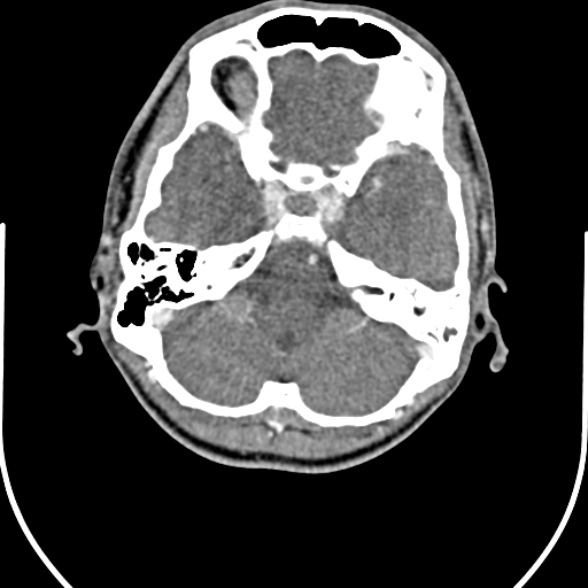 File:Nasopharyngeal carcinoma with skull base invasion (Radiopaedia 53415-59705 A 8).jpg