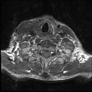 File:Nasopharyngeal carcinoma with skull base invasion (Radiopaedia 59258-66600 Axial T1 15).jpg