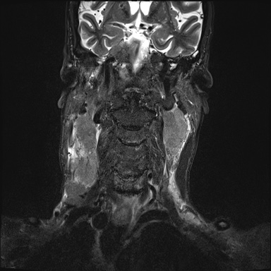 Nasopharyngeal carcinoma with skull base invasion (Radiopaedia 59258-66600 Coronal T2 fat sat 14).jpg