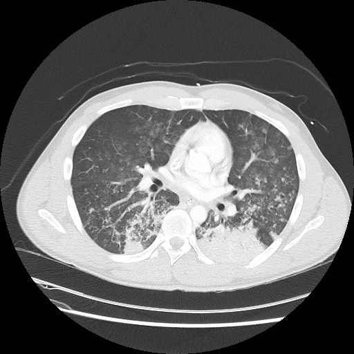 Near-drowning pulmonary edema (Radiopaedia 59457-66814 Axial lung window 30).jpg