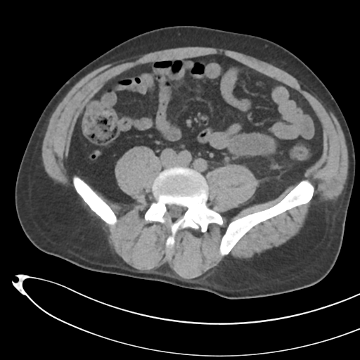 File:Necrotizing pancreatitis with acute necrotic collections (Radiopaedia 38829-41012 Axial non-contrast 53).png
