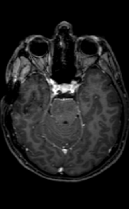 Neuro-Behçet disease (Radiopaedia 90112-107294 Axial T1 C+ 154).jpg