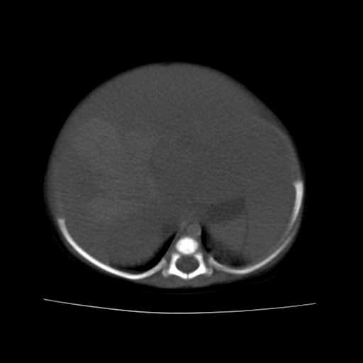 File:Neuroblastoma (Radiopaedia 20876-20799 Axial non-contrast 6).jpg