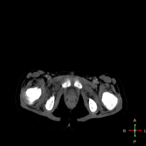 File:Neuroblastoma (Radiopaedia 24751-25016 D 46).jpg