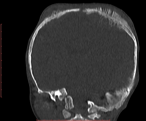 File:Neuroblastoma skull metastasis (Radiopaedia 56053-62683 Coronal bone window 23).jpg