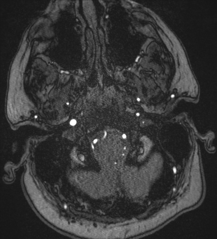 Neurofibromatosis type 1 - head and neck - CNS manifestations (Radiopaedia 49910-55188 Axial MRA 2).png